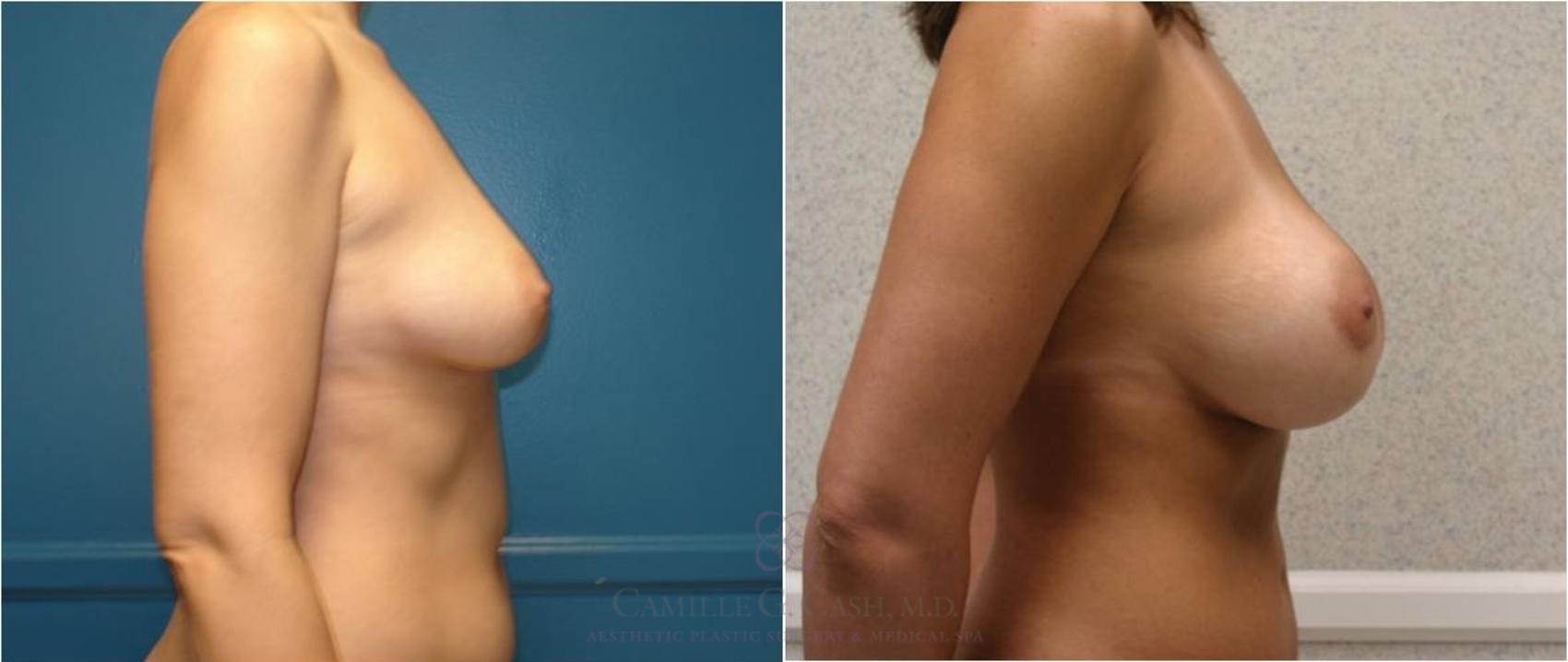 Before & After Breast Augmentation Case 24 View #6 View in Houston, TX