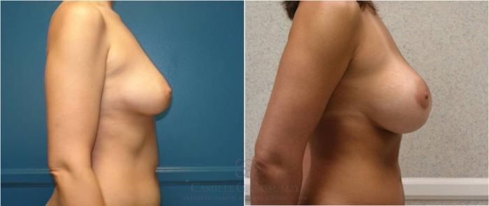 Before & After Breast Augmentation Case 24 View #6 View in Houston, TX