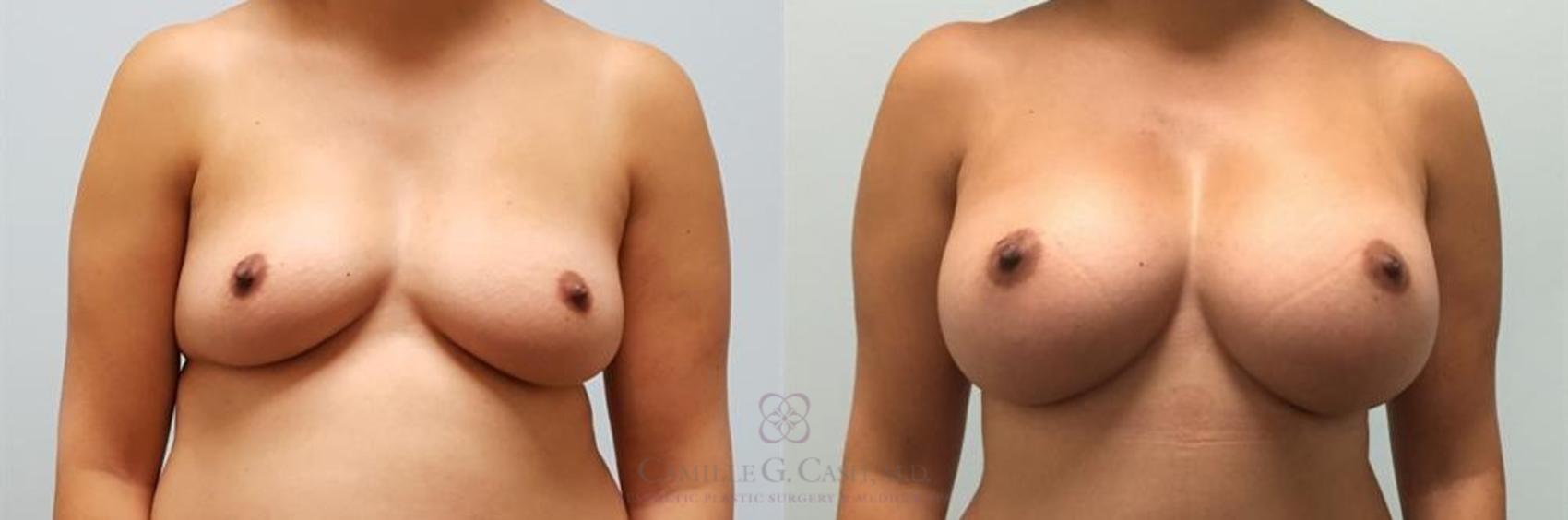 Before & After Breast Augmentation Case 247 View #1 View in Houston, TX