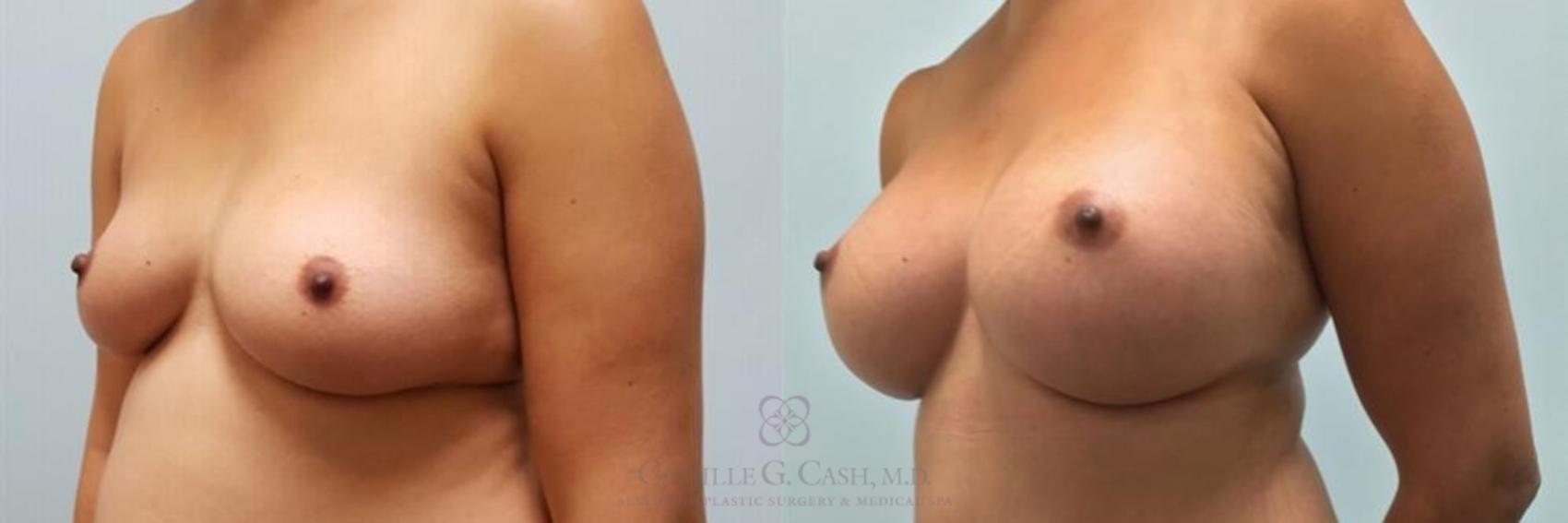 Before & After Breast Augmentation Case 247 View #2 View in Houston, TX