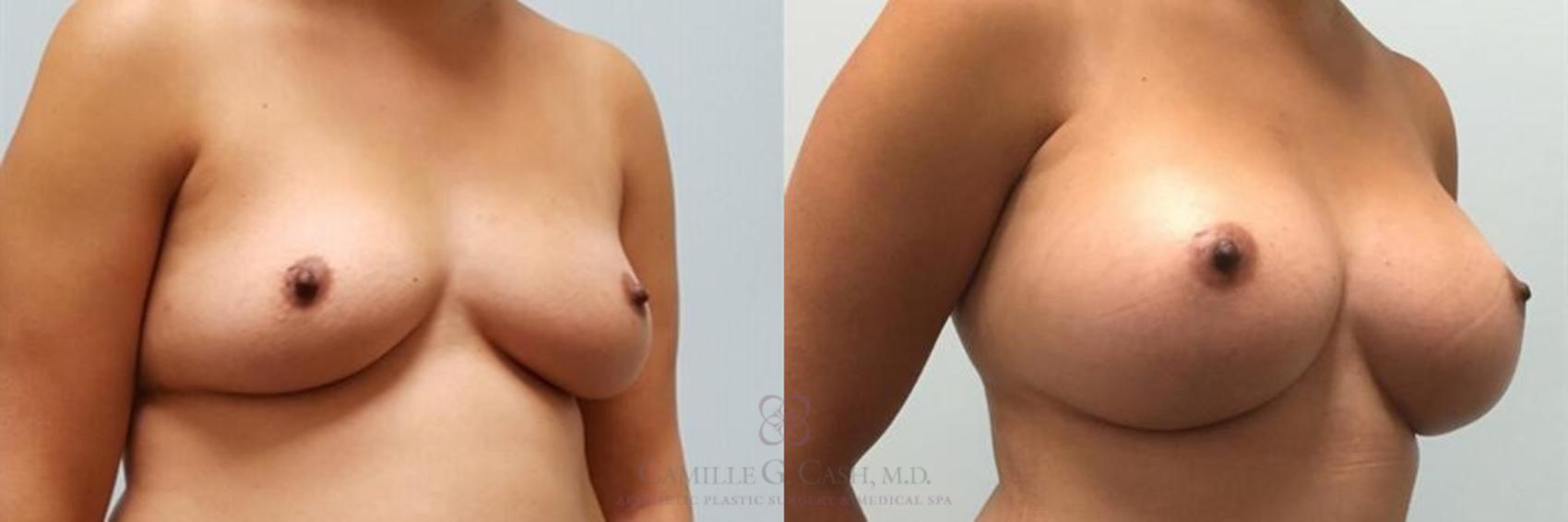 Before & After Breast Augmentation Case 247 View #3 View in Houston, TX