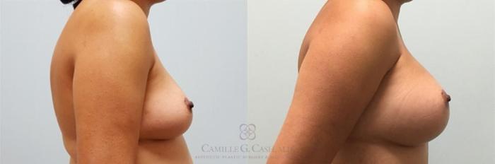 Before & After Breast Augmentation Case 247 View #4 View in Houston, TX