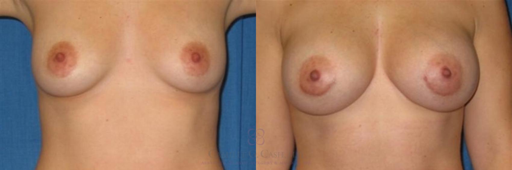 Before & After Breast Augmentation Case 258 View #1 View in Houston, TX