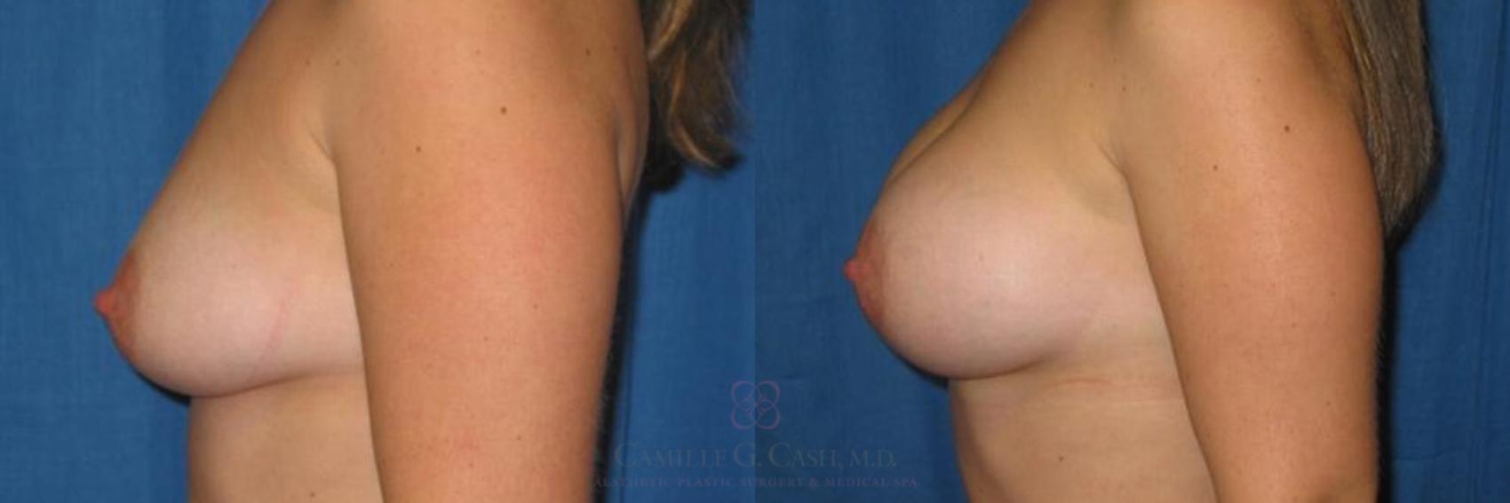 Before & After Breast Augmentation Case 258 View #2 View in Houston, TX