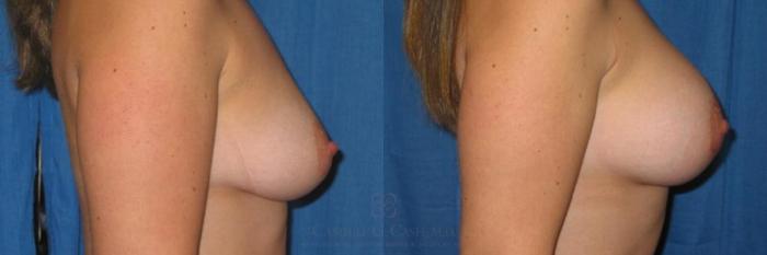 Before & After Breast Augmentation Case 258 View #3 View in Houston, TX