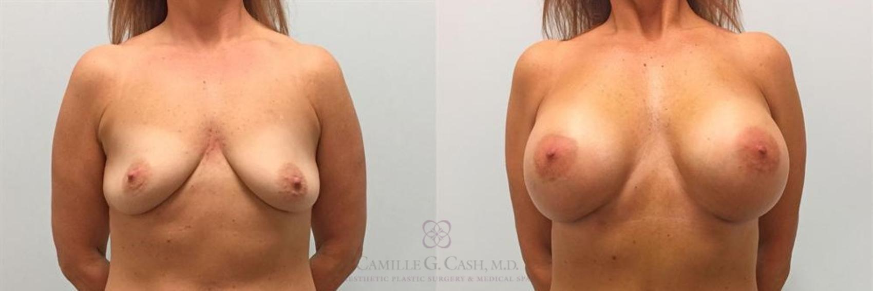 Before & After Breast Augmentation Case 263 View #1 View in Houston, TX
