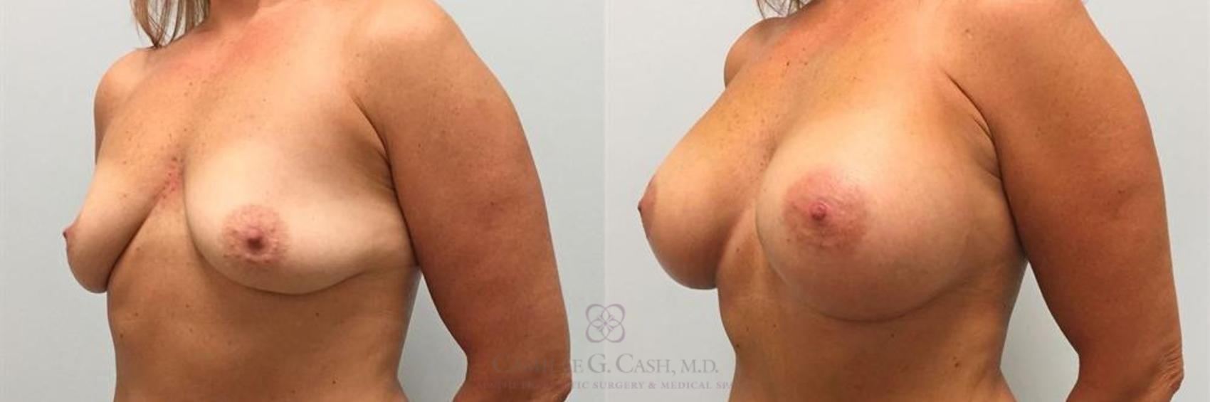 Before & After Breast Augmentation Case 263 View #2 View in Houston, TX