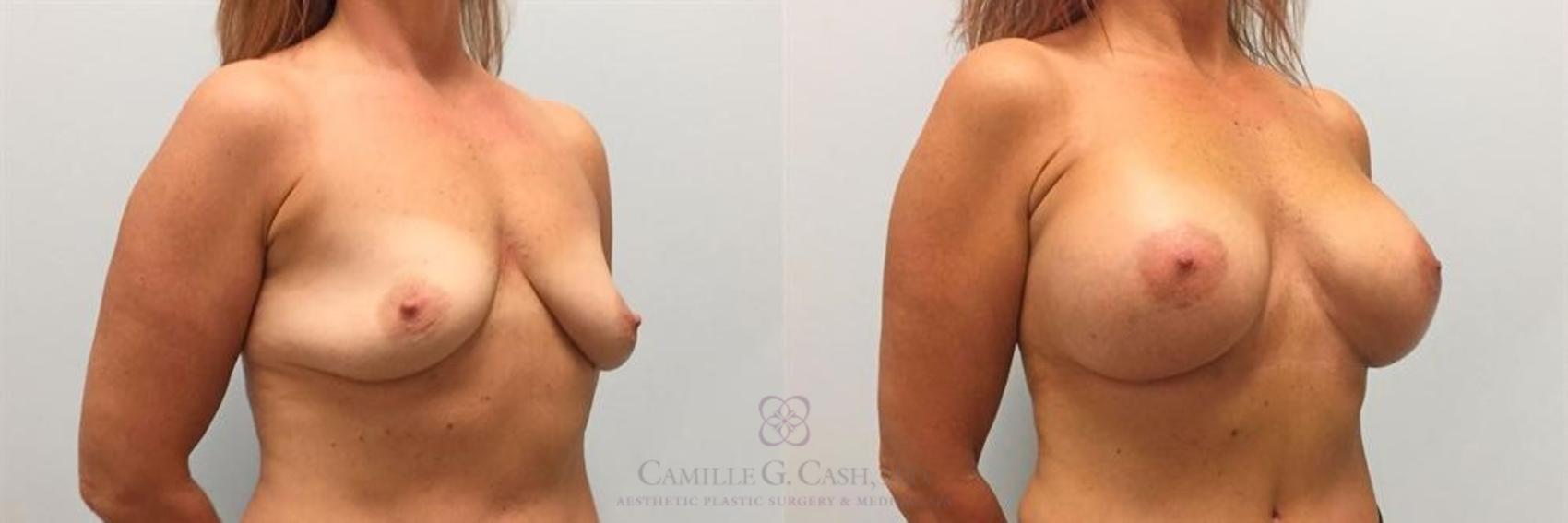 Before & After Breast Augmentation Case 263 View #3 View in Houston, TX