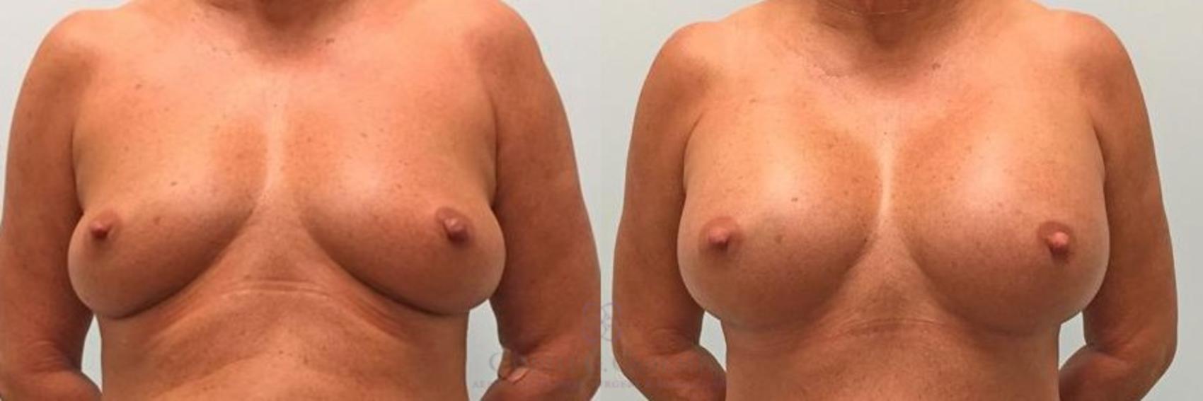 Before & After Breast Augmentation Case 269 View #1 View in Houston, TX