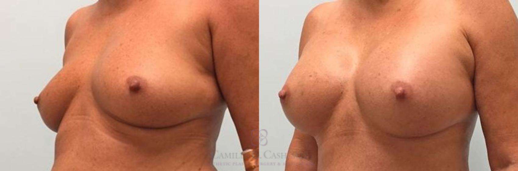 Before & After Breast Augmentation Case 269 View #2 View in Houston, TX
