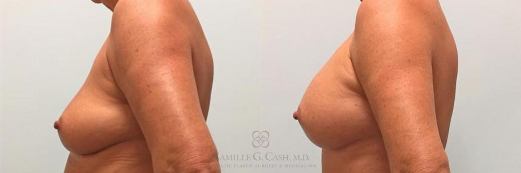 Before & After Breast Augmentation Case 269 View #3 View in Houston, TX