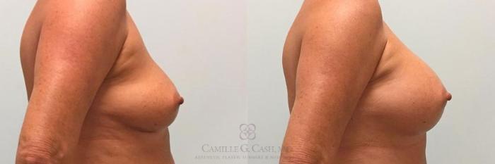 Before & After Breast Augmentation Case 269 View #4 View in Houston, TX