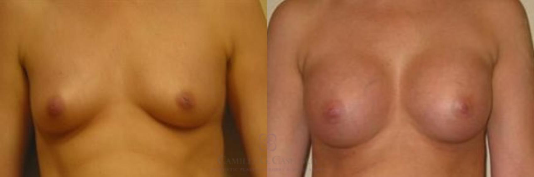 Before & After Breast Augmentation Case 277 View #1 View in Houston, TX