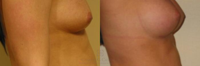 Before & After Breast Augmentation Case 277 View #2 View in Houston, TX