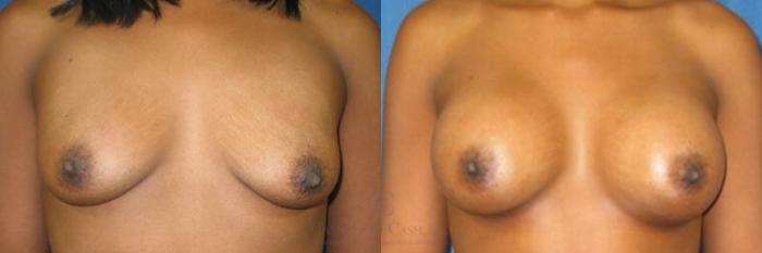 Before & After Breast Augmentation Case 282 View #1 View in Houston, TX