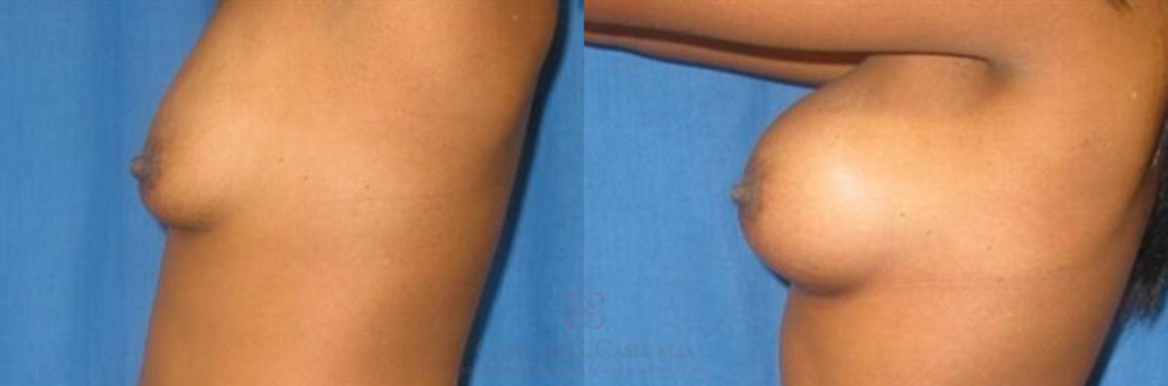 Before & After Breast Augmentation Case 282 View #2 View in Houston, TX