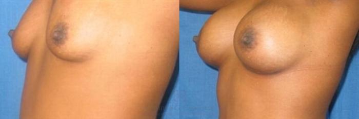 Before & After Breast Augmentation Case 282 View #3 View in Houston, TX