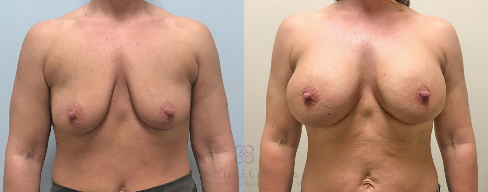 Before & After Breast Augmentation Case 306 View #1 View in Houston, TX