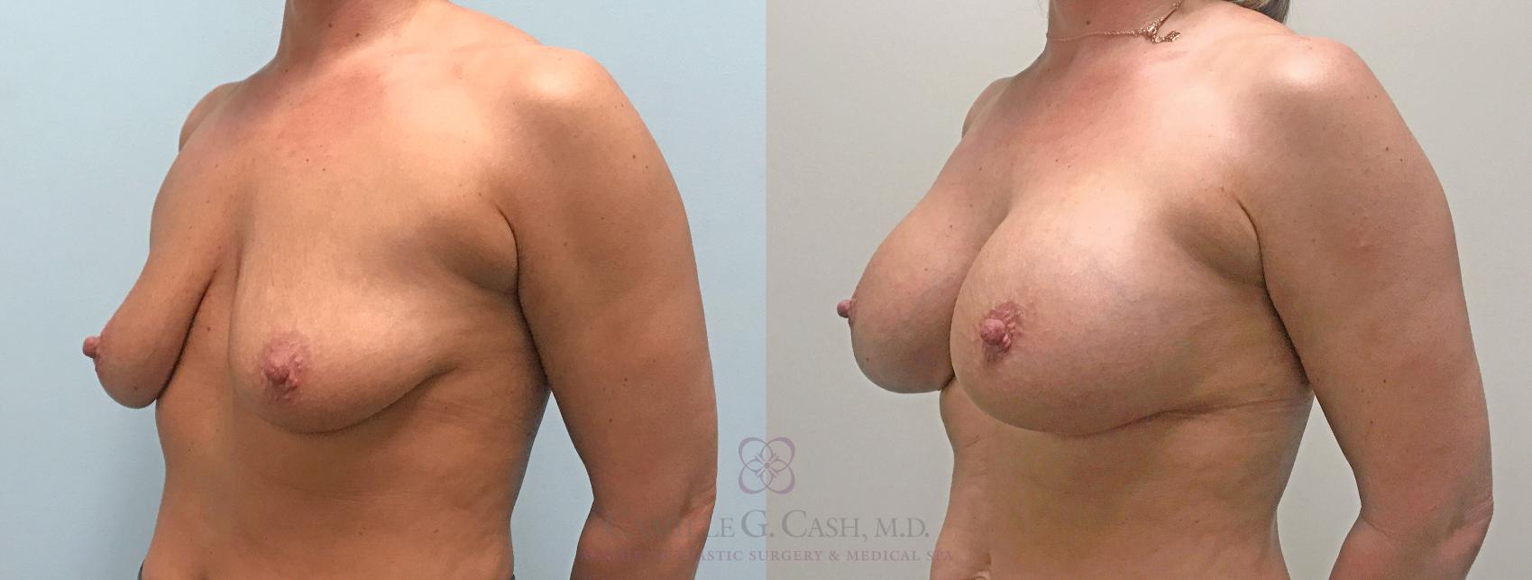 Before & After Breast Augmentation Case 306 View #2 View in Houston, TX