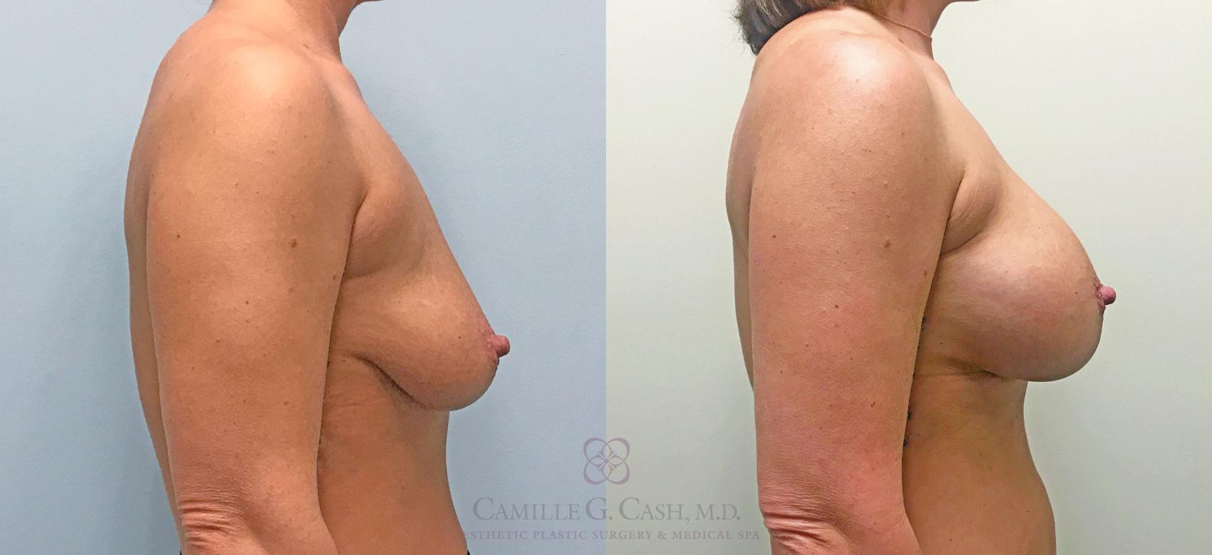 Before & After Breast Augmentation Case 306 View #3 View in Houston, TX