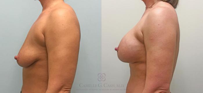Before & After Breast Augmentation Case 306 View #4 View in Houston, TX
