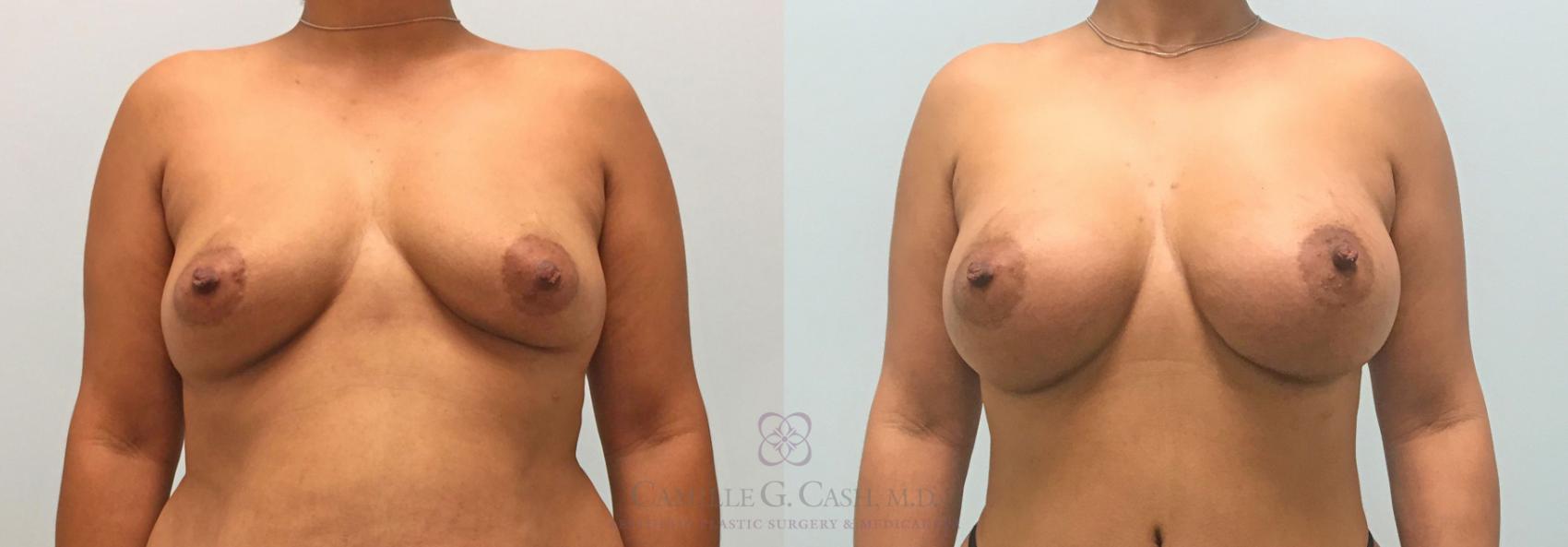 Before & After Breast Augmentation Case 307 View #1 View in Houston, TX