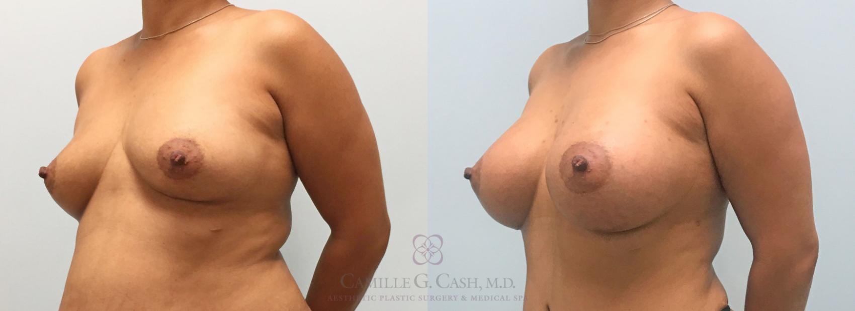 Before & After Breast Augmentation Case 307 View #2 View in Houston, TX