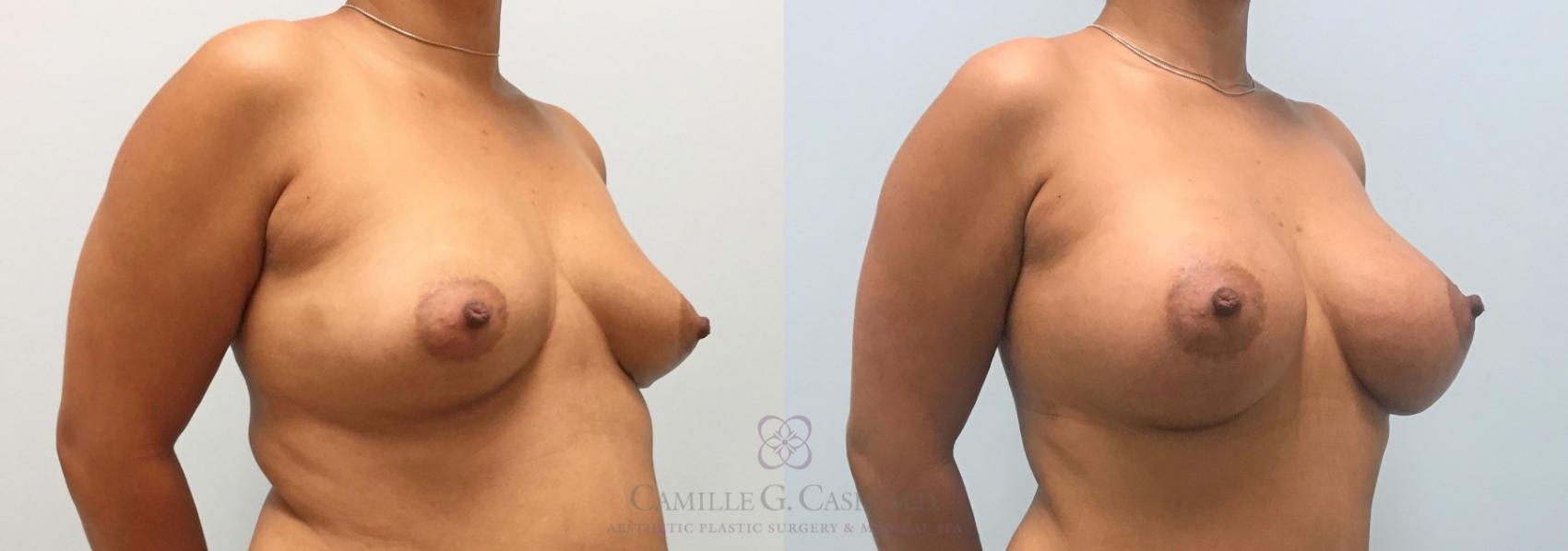 Before & After Breast Augmentation Case 307 View #3 View in Houston, TX