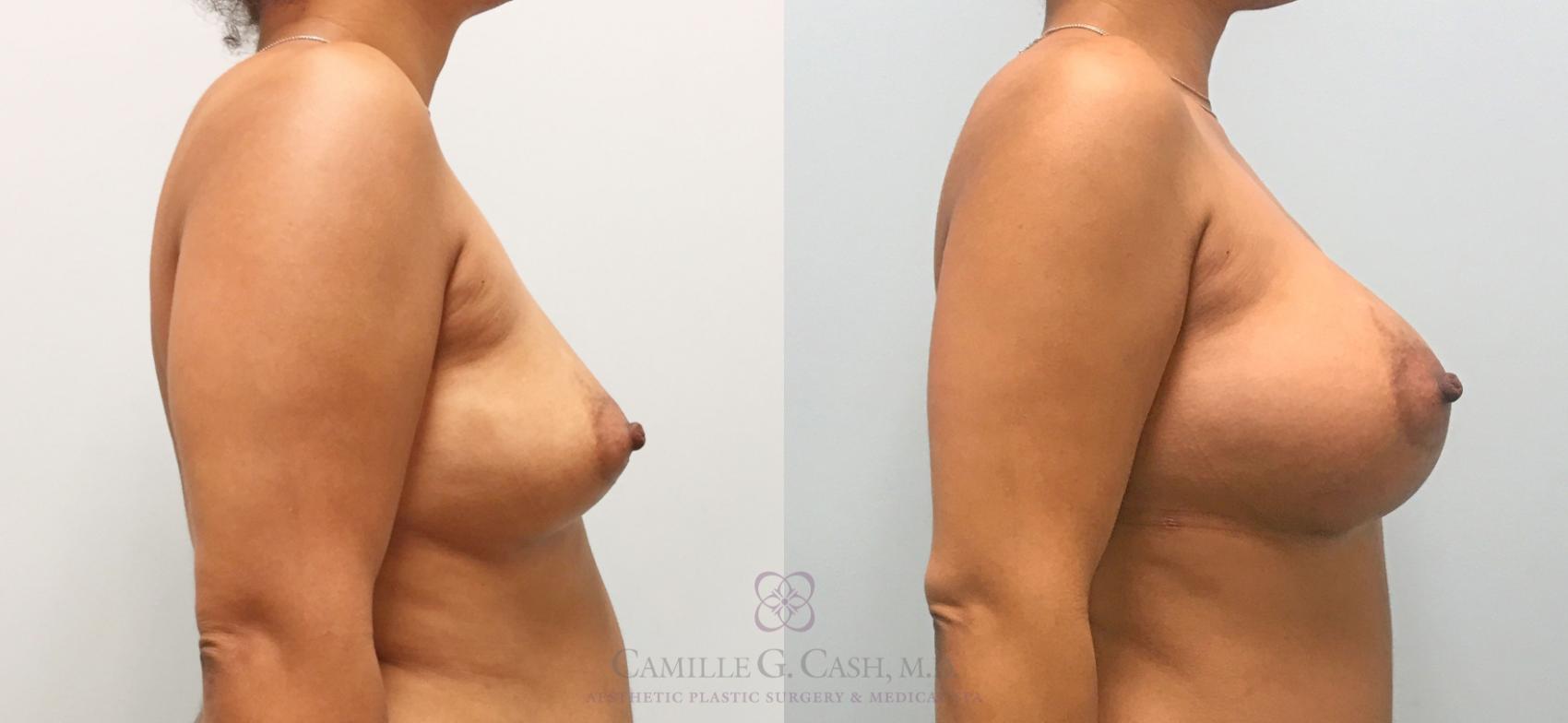 Before & After Breast Augmentation Case 307 View #4 View in Houston, TX