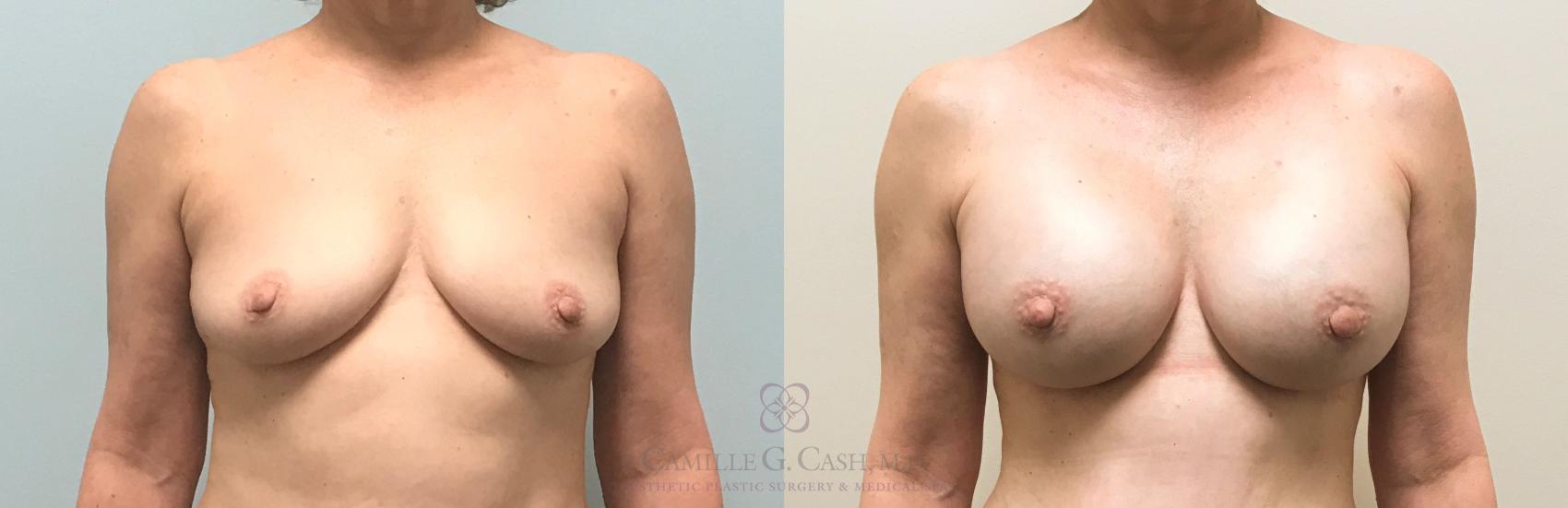 Before & After Breast Augmentation Case 312 View #1 View in Houston, TX