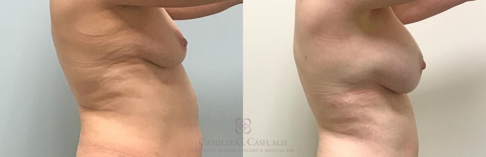 Before & After Breast Augmentation Case 312 View #2 View in Houston, TX