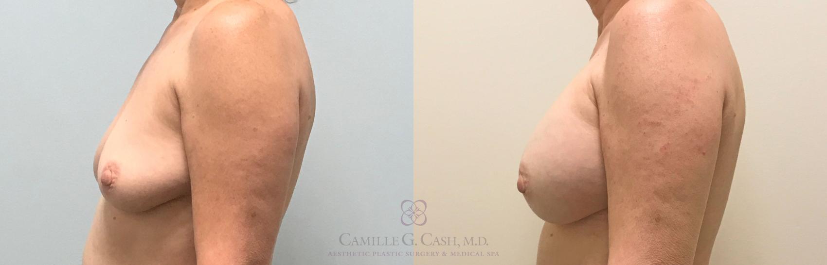 Before & After Breast Augmentation Case 312 View #3 View in Houston, TX