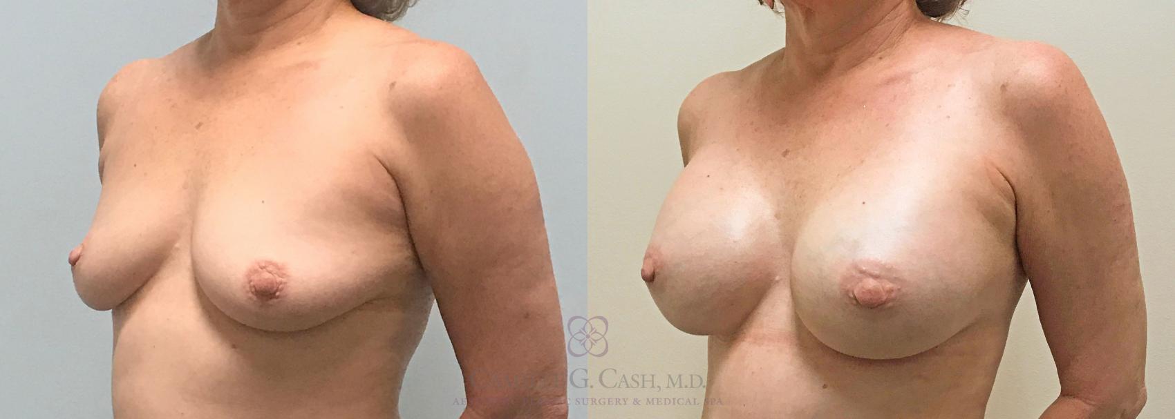 Before & After Breast Augmentation Case 312 View #4 View in Houston, TX