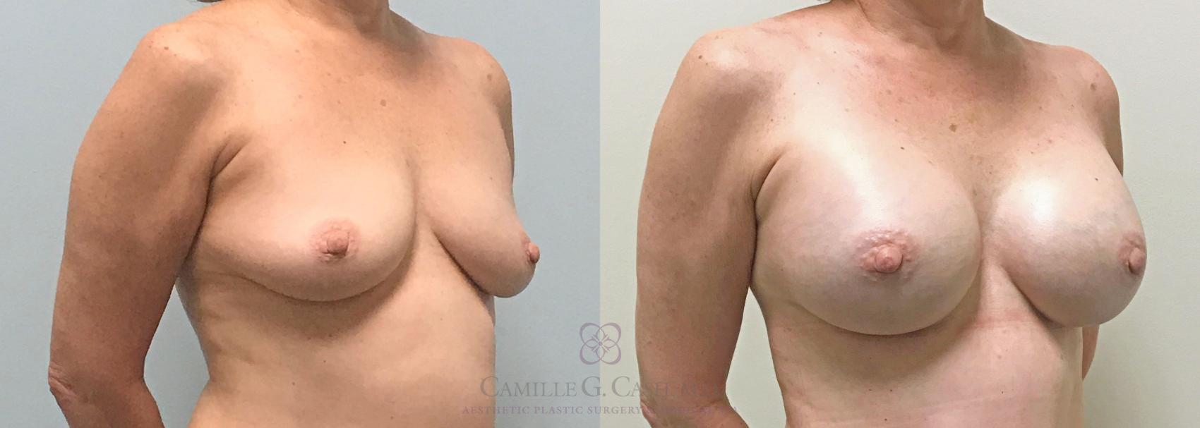 Before & After Breast Augmentation Case 312 View #5 View in Houston, TX