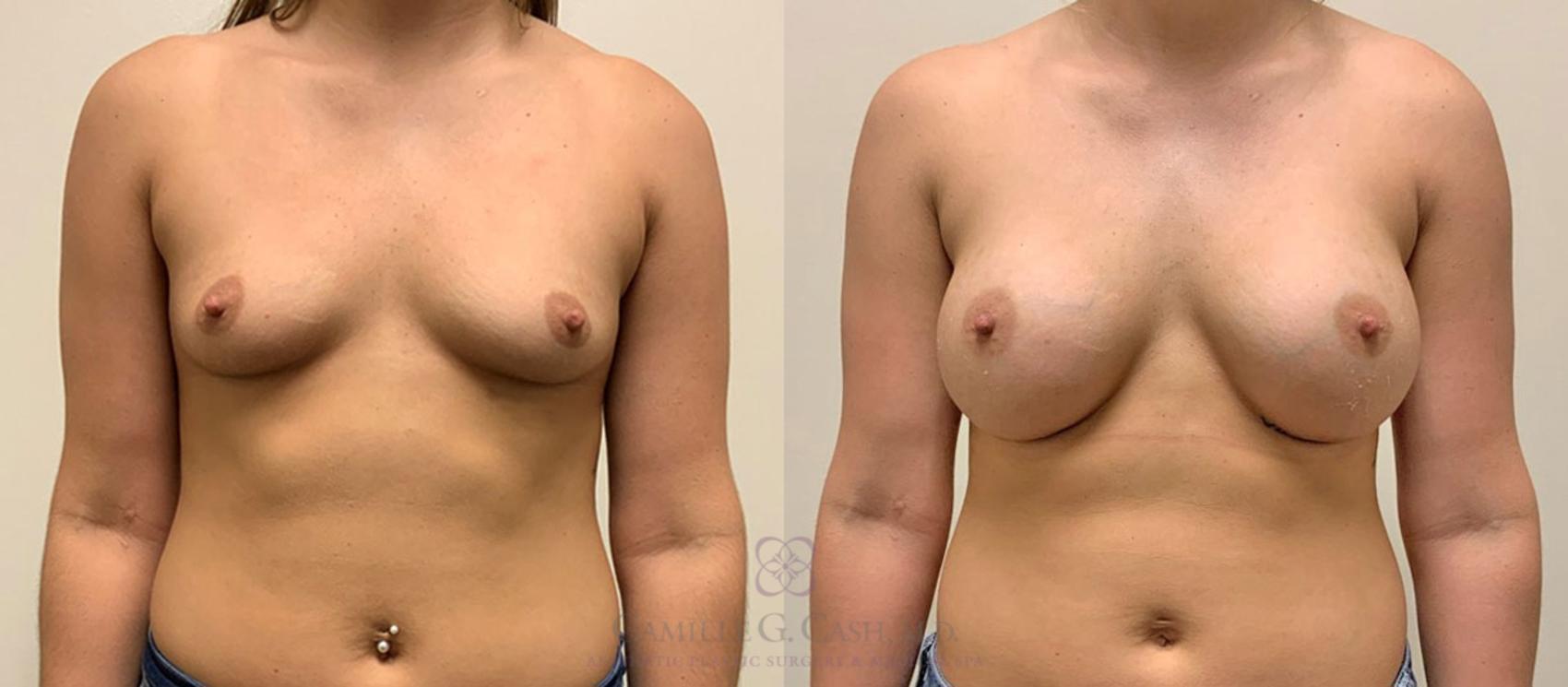 Before & After Breast Augmentation Case 347 View #1 View in Houston, TX