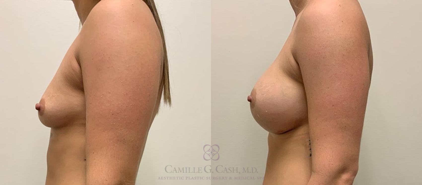 Before & After Breast Augmentation Case 347 View #2 View in Houston, TX