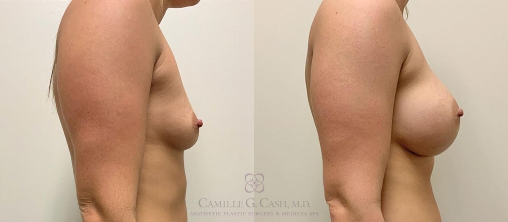 Before & After Breast Augmentation Case 347 View #3 View in Houston, TX