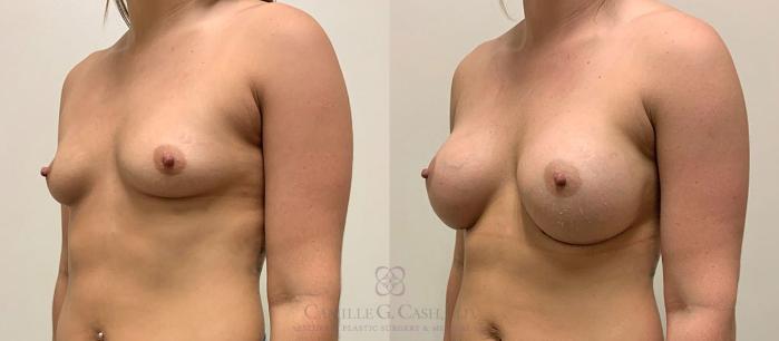 Before & After Breast Augmentation Case 347 View #4 View in Houston, TX