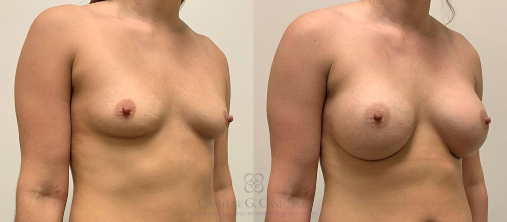 Before & After Breast Augmentation Case 347 View #5 View in Houston, TX