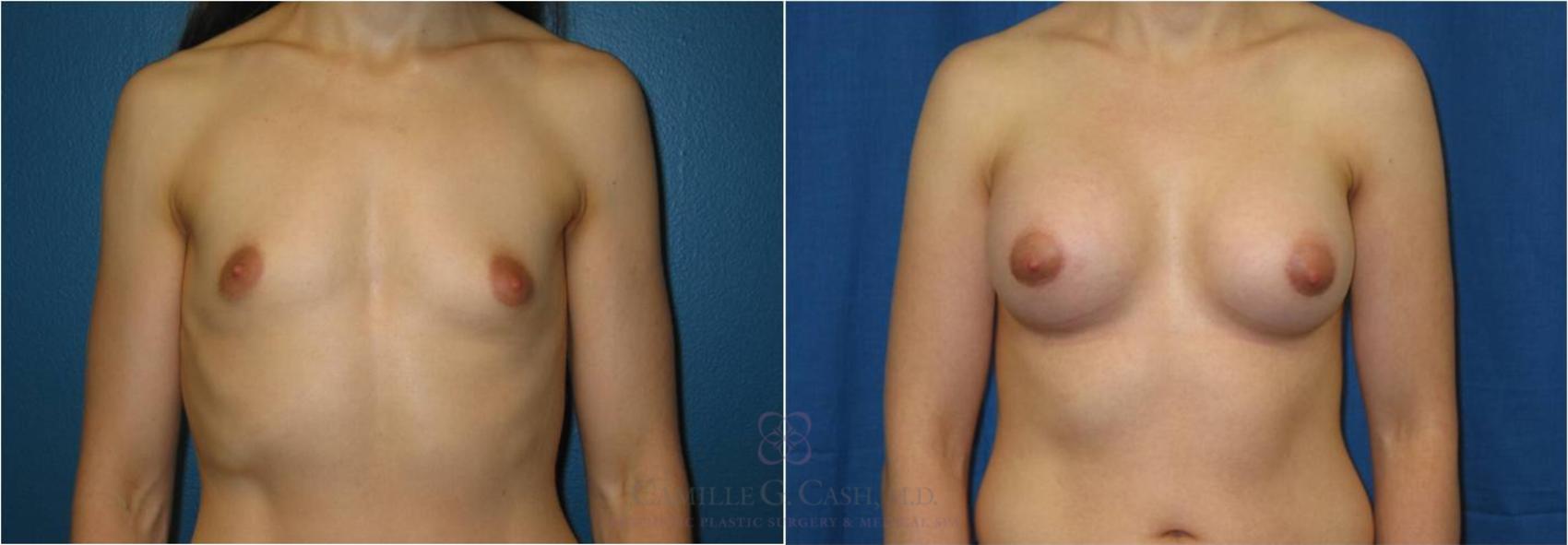 Before & After Breast Augmentation Case 38 View #1 View in Houston, TX