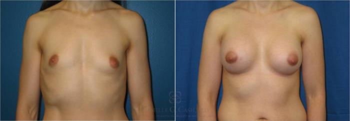 Before & After Breast Augmentation Case 38 View #1 View in Houston, TX