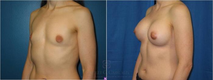 Before & After Breast Augmentation Case 38 View #2 View in Houston, TX