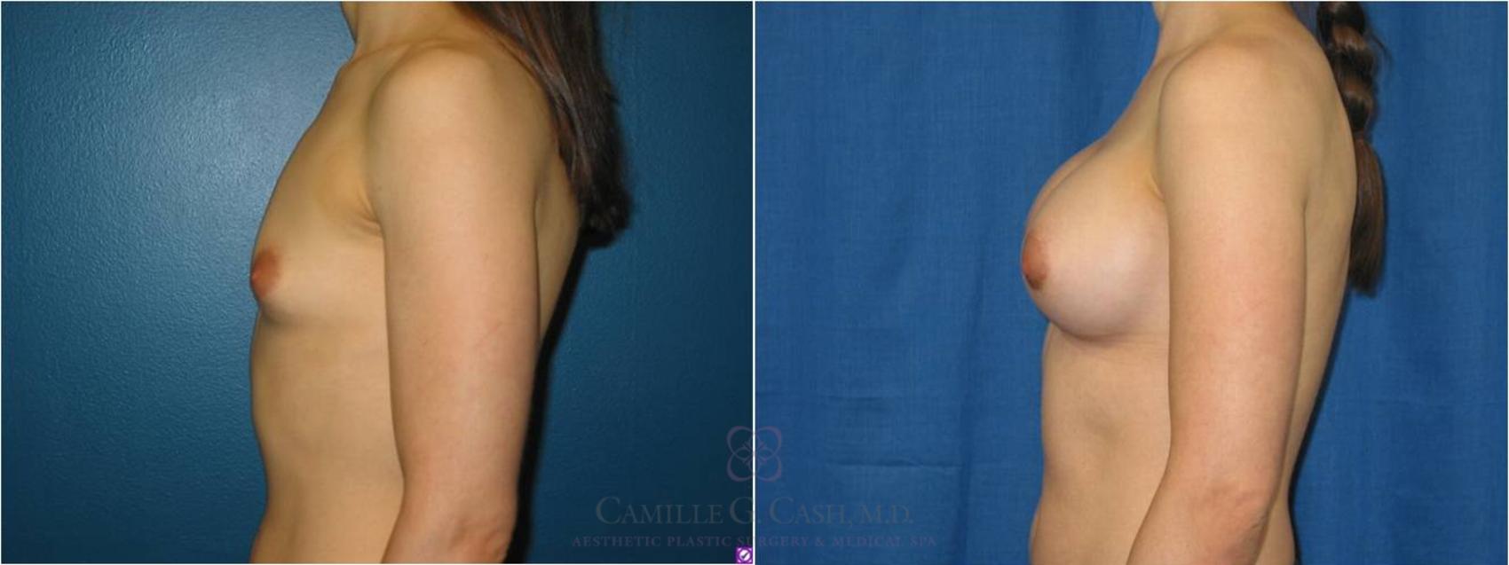 Before & After Breast Augmentation Case 38 View #3 View in Houston, TX