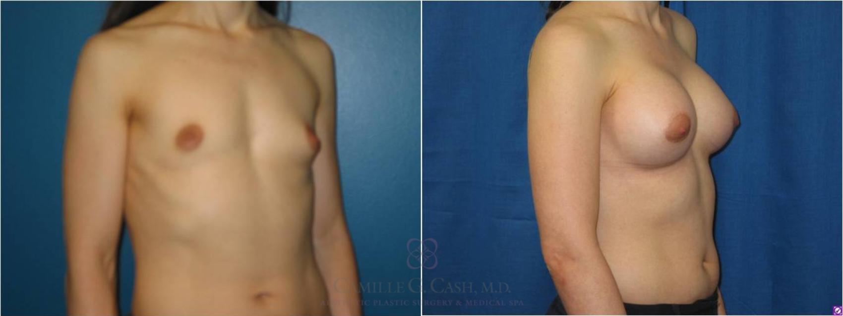 Before & After Breast Augmentation Case 38 View #5 View in Houston, TX
