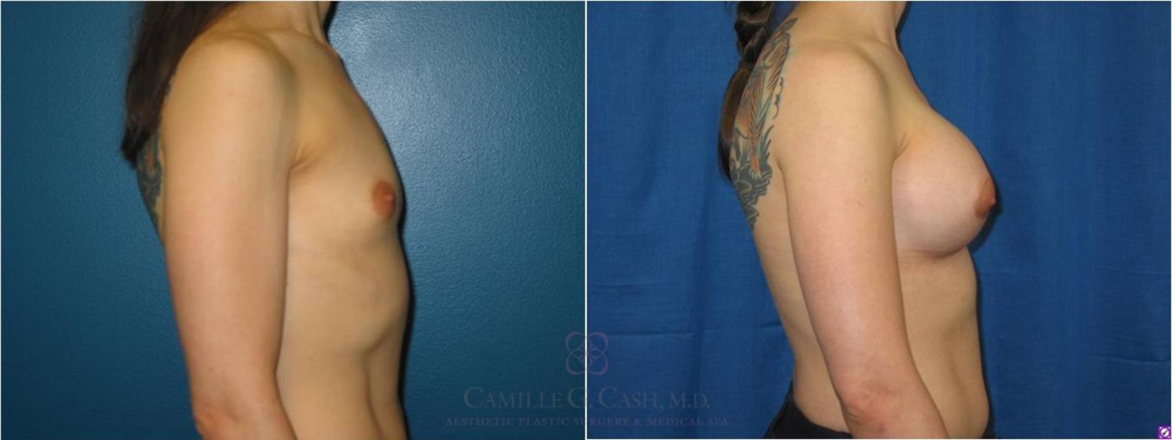 Before & After Breast Augmentation Case 38 View #6 View in Houston, TX