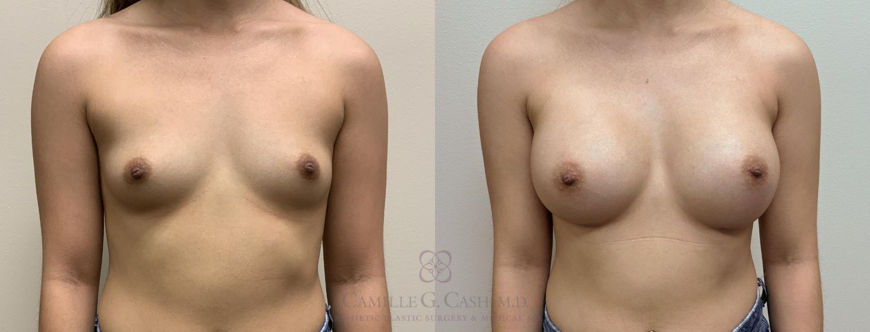Before & After Breast Augmentation Case 390 View #1 View in Houston, TX