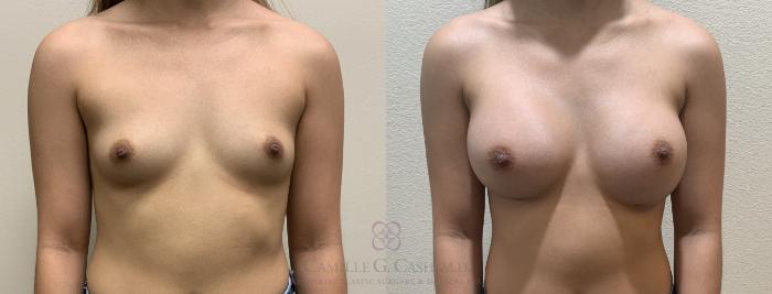 Before & After Breast Augmentation Case 390 View #2 View in Houston, TX