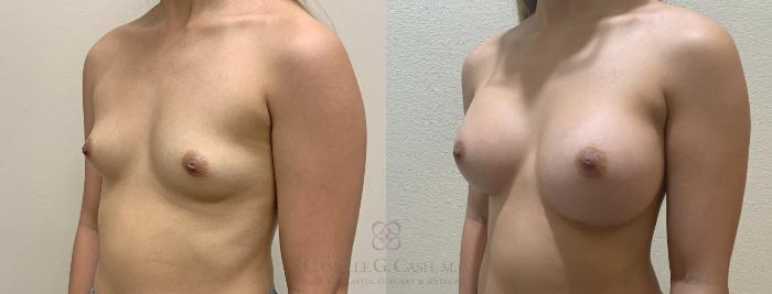 Before & After Breast Augmentation Case 390 View #3 View in Houston, TX