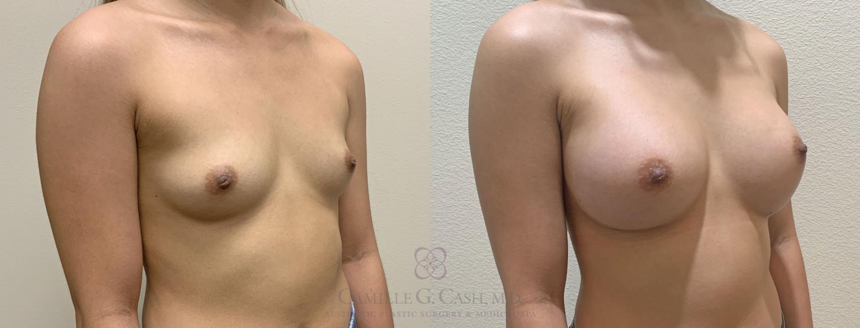 Before & After Breast Augmentation Case 390 View #4 View in Houston, TX