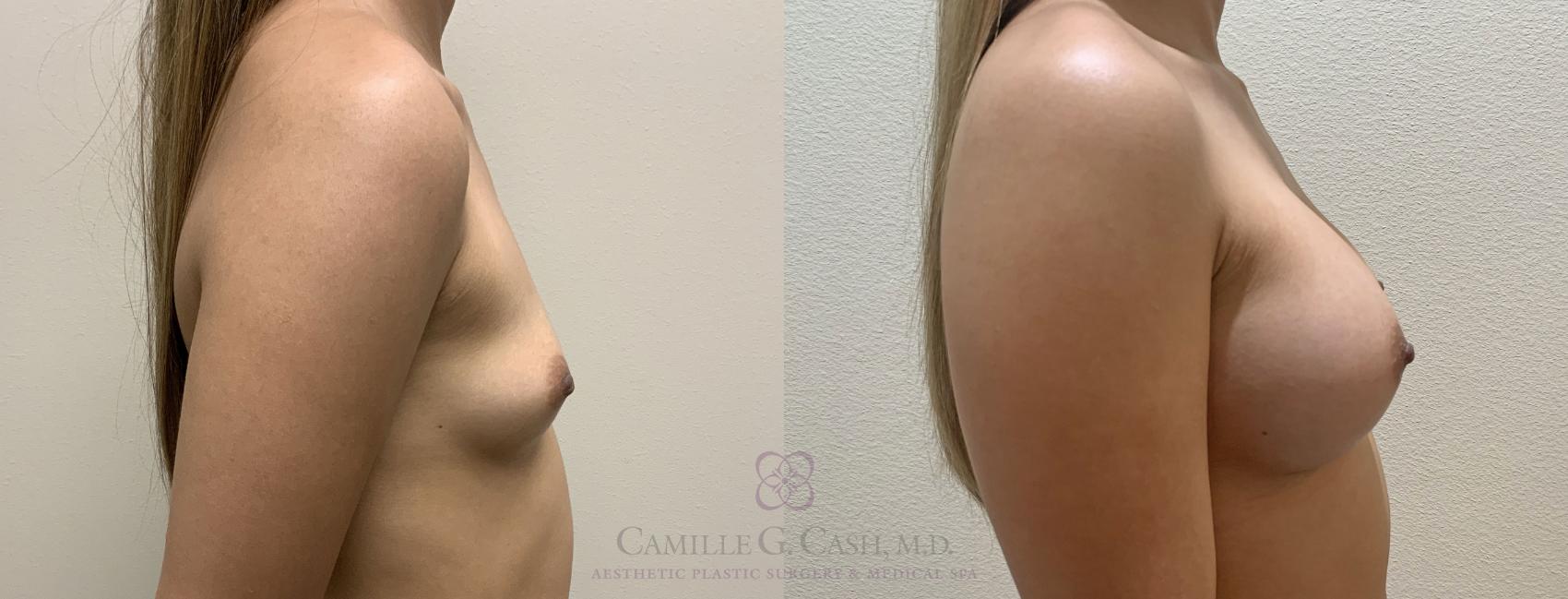 Before & After Breast Augmentation Case 390 View #5 View in Houston, TX